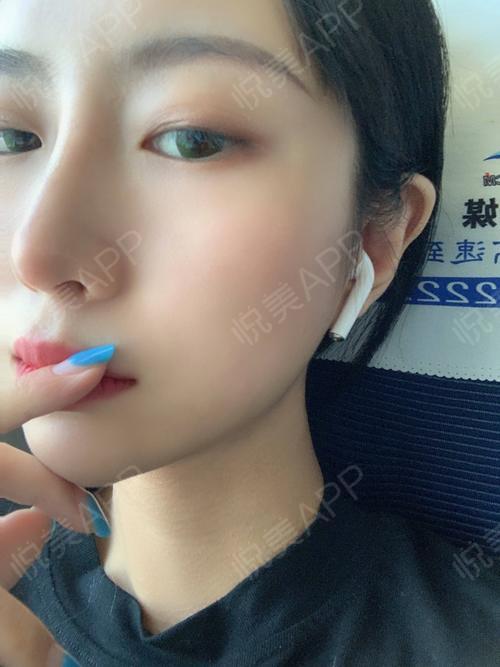 鼻综合整形术后50天_垫鼻尖术后50天_垫鼻基底术后50天_鼻型矫正术后