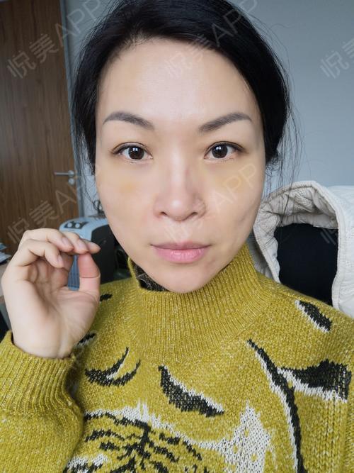 眶隔释放去眼袋术后1天_激光去眼袋术后1天_去眼袋术后1天_眼部整形术