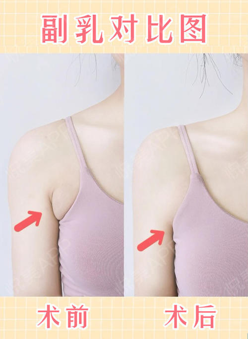 手术去副乳案例分享摆脱腋下两坨肉原来副乳才