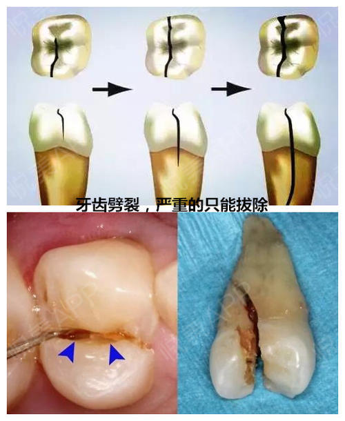 牙齿裂开了花!好后悔.怎么办?