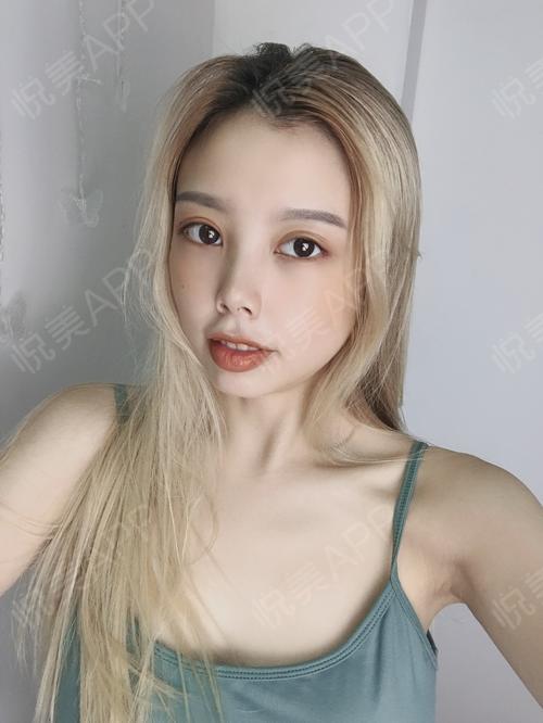 假体隆胸术后18天_隆胸术后18天_胸部整形术后18天_情人baby分享图片3