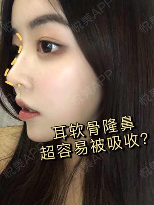 耳软骨那么容易被吸收,医生为什么还要用耳软骨隆鼻?_悦美整形