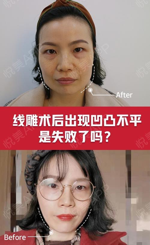 做完线雕出现凹凸不平是做失败了吗?