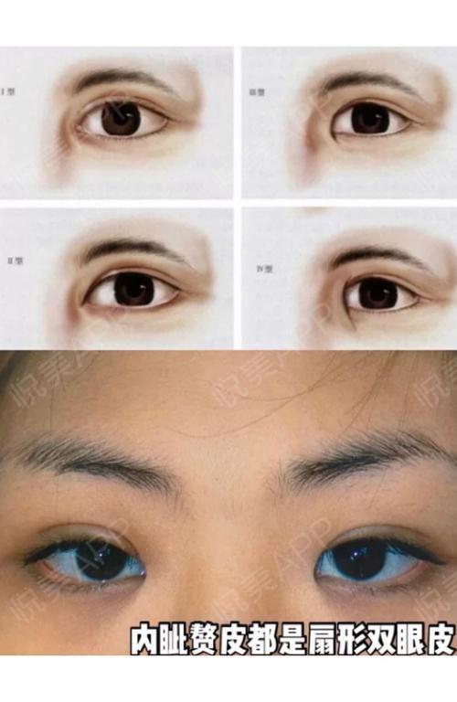 内眦赘皮会影响眼睛的形态吗
