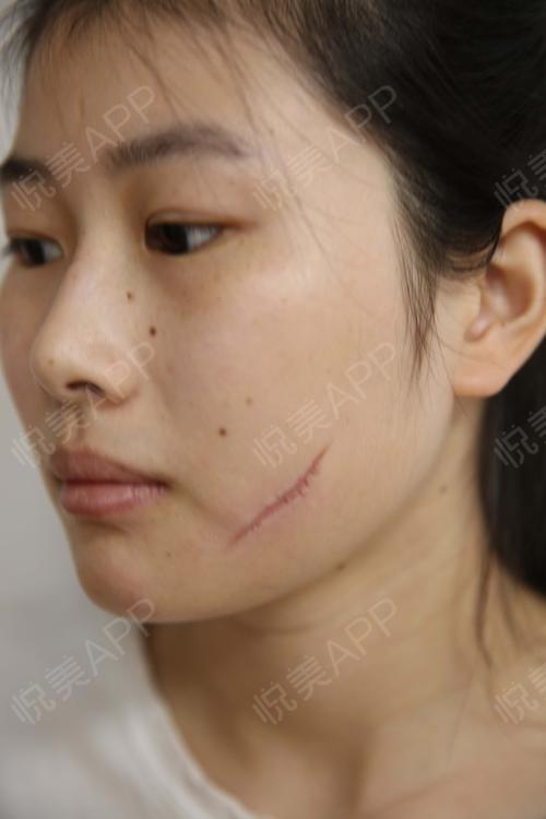 脸上划伤后留下了比较长的一条疤痕,边缘还有划拉很不整齐,简直是丑爆