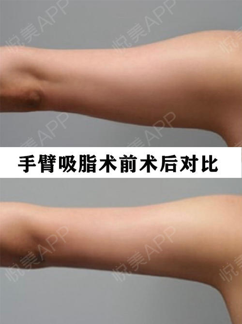 广州荔医案例手臂吸脂术前术后对比