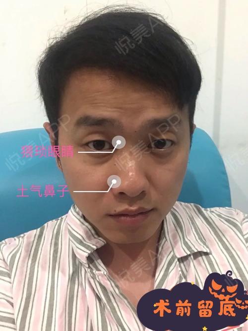 术后3个月78:手术要点:调整弯曲鼻中隔既保证鼻通气功能又保证鼻子