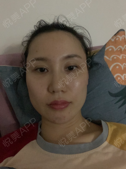 打完立马就溶解了,回到以前嘴巴显凸,不打以前的玻尿酸总是长痘发炎