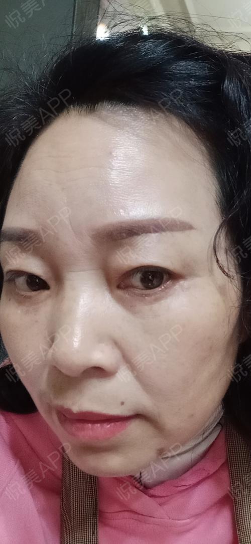 切眉提眉术后63天_激光去眼袋术后63天_内切去眼袋术后63天_眼周年轻