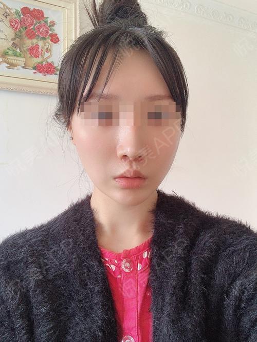 手术去露龈笑术后30天_唇型美化术后30天_口唇整形术后30天_悦mer_015