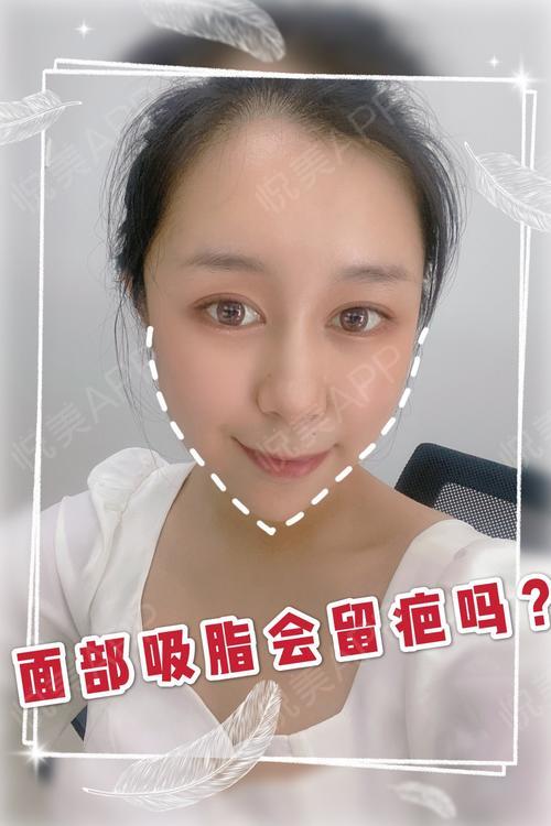 面部吸脂会留疤吗面部吸脂后多久能恢复有人说