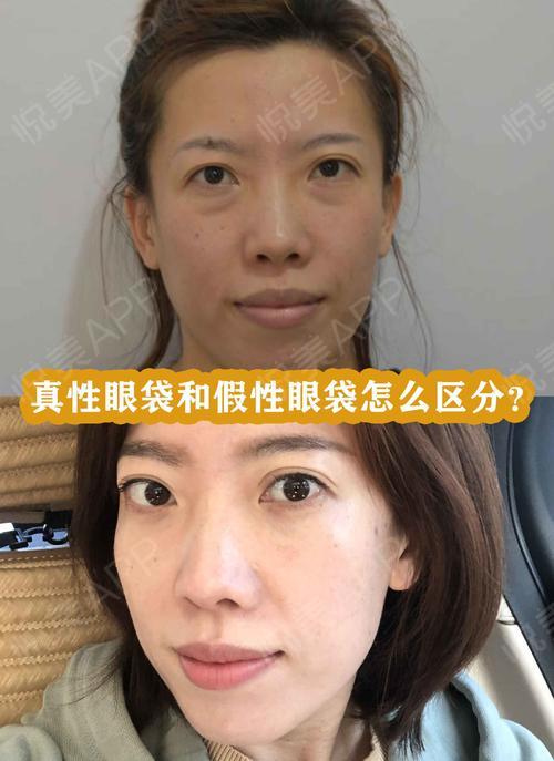 【怎么区分真性眼袋和假性眼袋?】