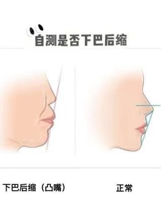 微调短圆下巴效果堪比换头