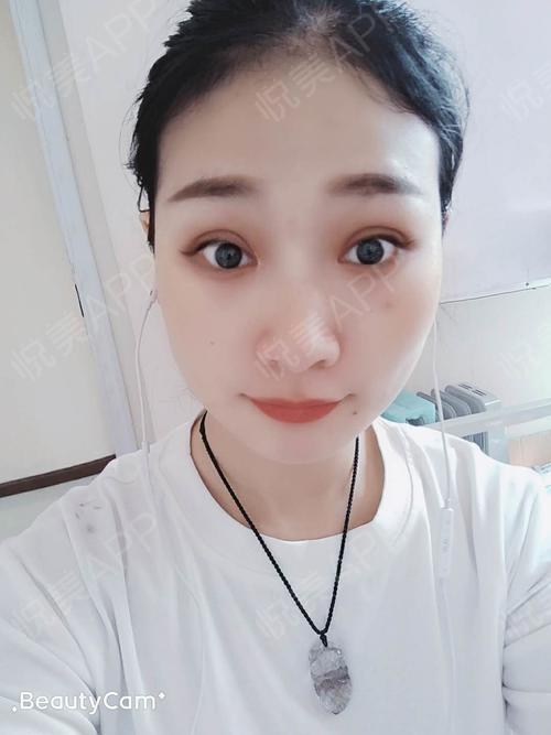 眼综合整形术后7天_开外眼角术后7天_眼型矫正术后7天_眼综合术后7天