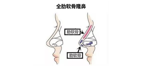 假体肋软骨结合的方式为什么比全肋鼻综合更受欢迎