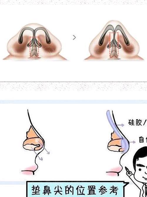 鼻子是由很多部分组成的,比如说鼻翼,鼻中隔,鼻小柱,鼻梁,鼻尖,鼻头等