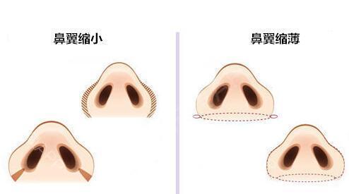 标准的美鼻鼻翼是什么样的?