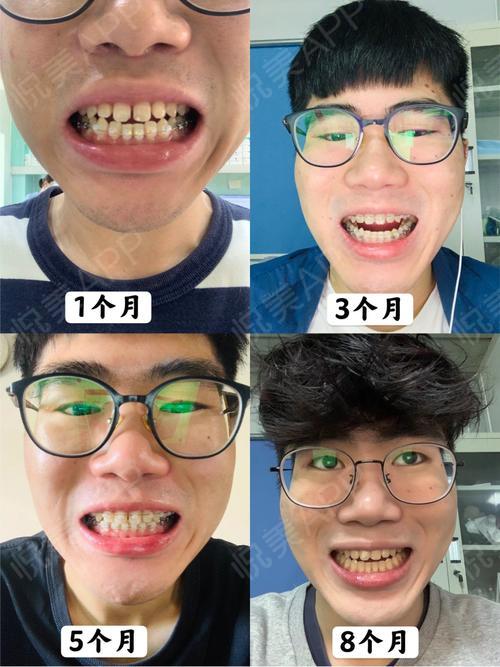 牙齿矫正案例|小哥哥牙齿稀疏8个月结束矫正