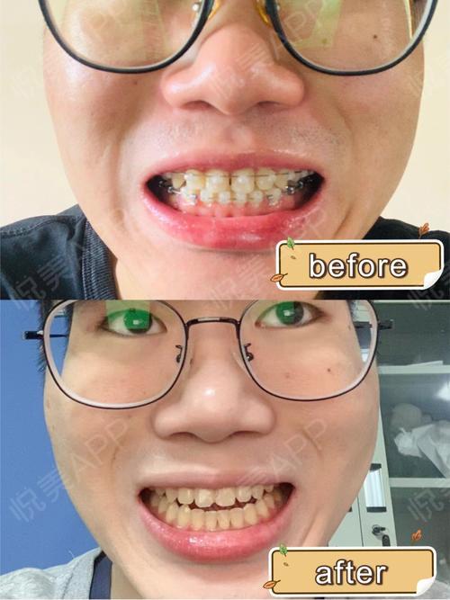 牙齿矫正案例|小哥哥牙齿稀疏8个月结束矫正