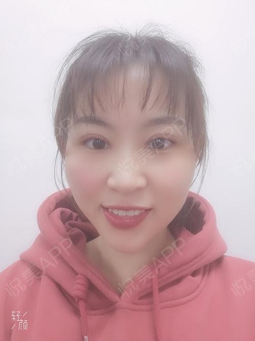 综合术后15天_开眼角术后15天_双眼皮术后15天_眼部整形术后15天_一叶