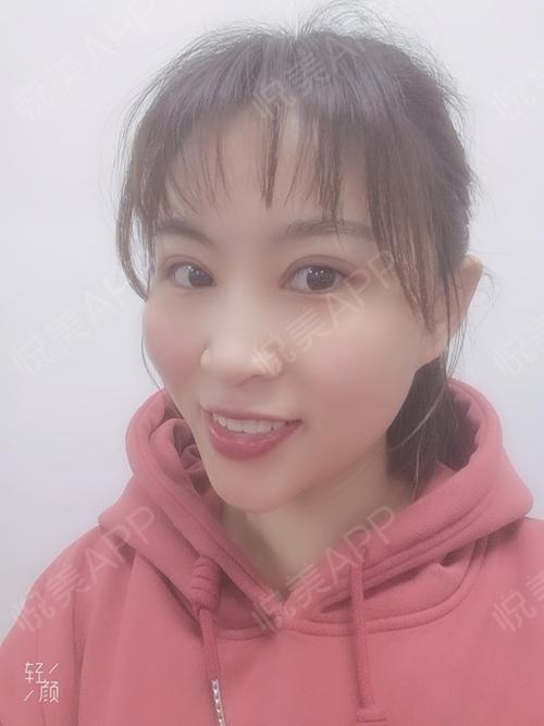 综合术后15天_开眼角术后15天_双眼皮术后15天_眼部整形术后15天_一叶