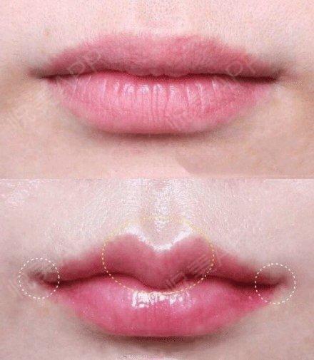唇珠可以用玻尿酸来填充吗?