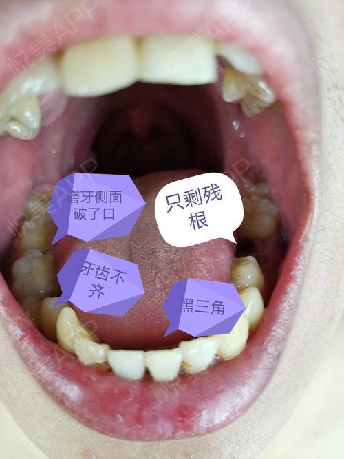 1一侧磨牙已经蛀空只剩下残根不疼