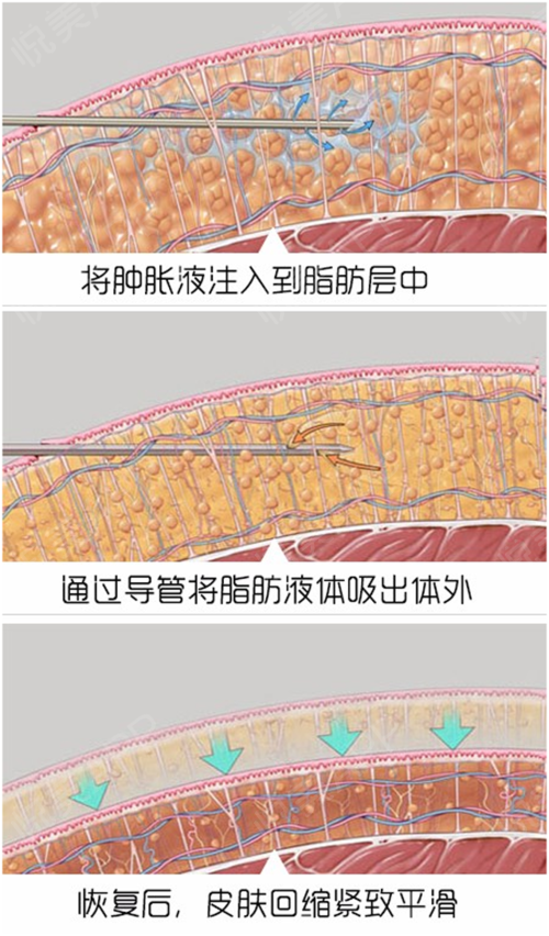 针会在皮下组织间形成扇形隧道,启动自身修复机制,促使纤维细胞增生