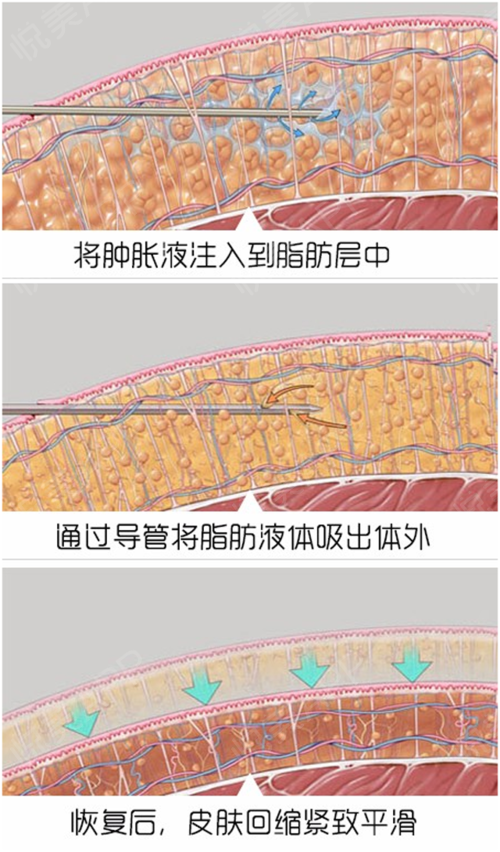 脂肪堆积的双下巴该如何改善