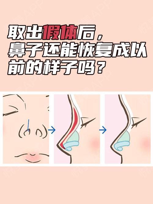 取出假体后,鼻子还能恢复成以前的样子吗?